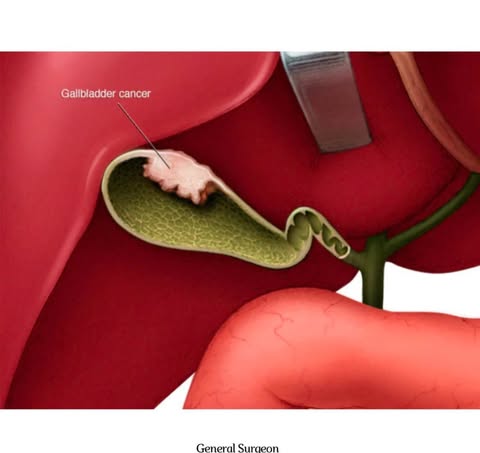 gallbladder
