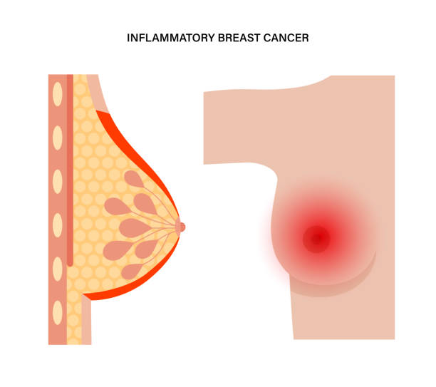 breast cancer