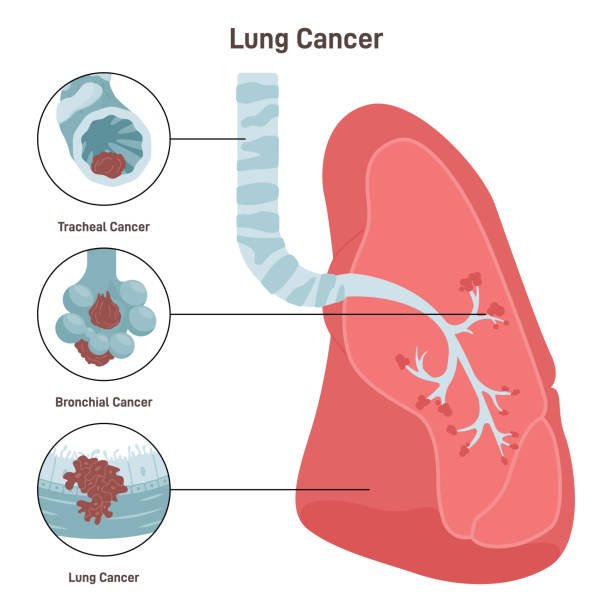 Lung Cancer