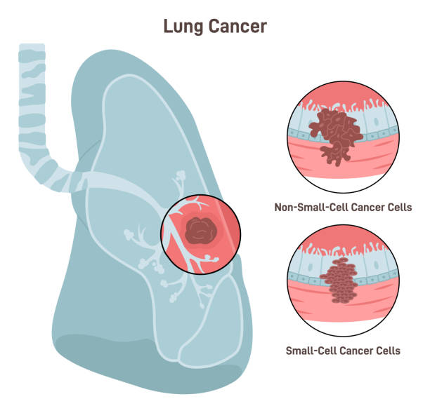 Lung Cancer