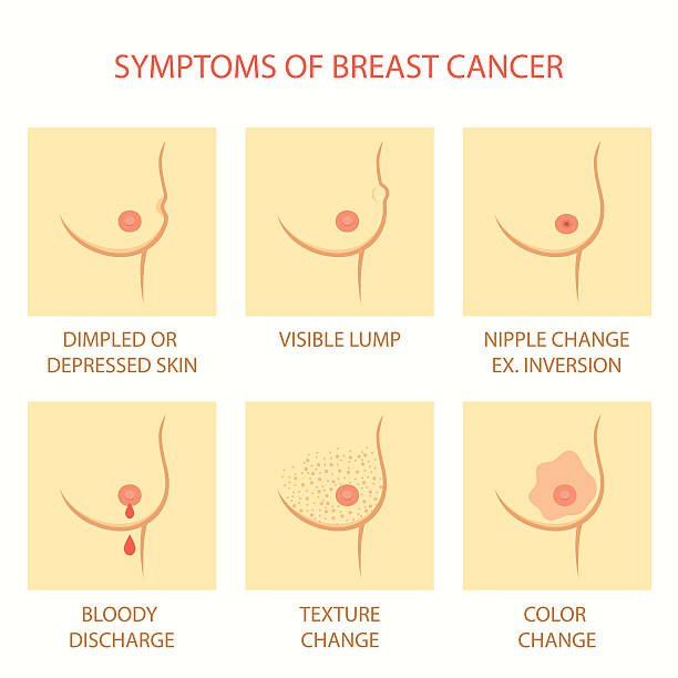 Breast Cancer