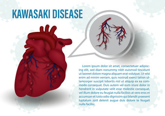 Kawasaki Disease Treatment