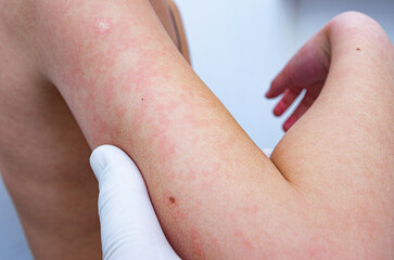 Hives vs. Rash