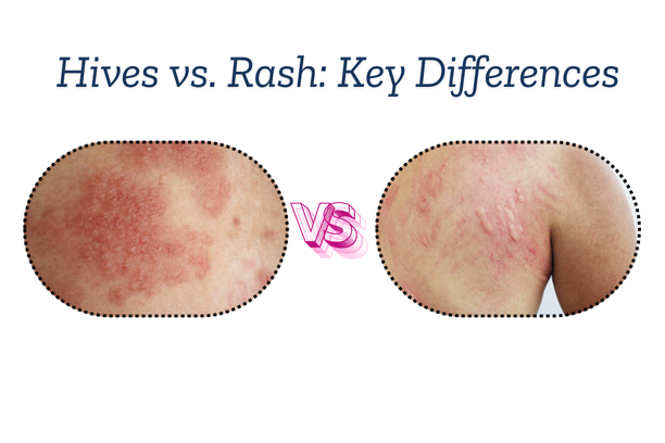 Hives vs. Rash