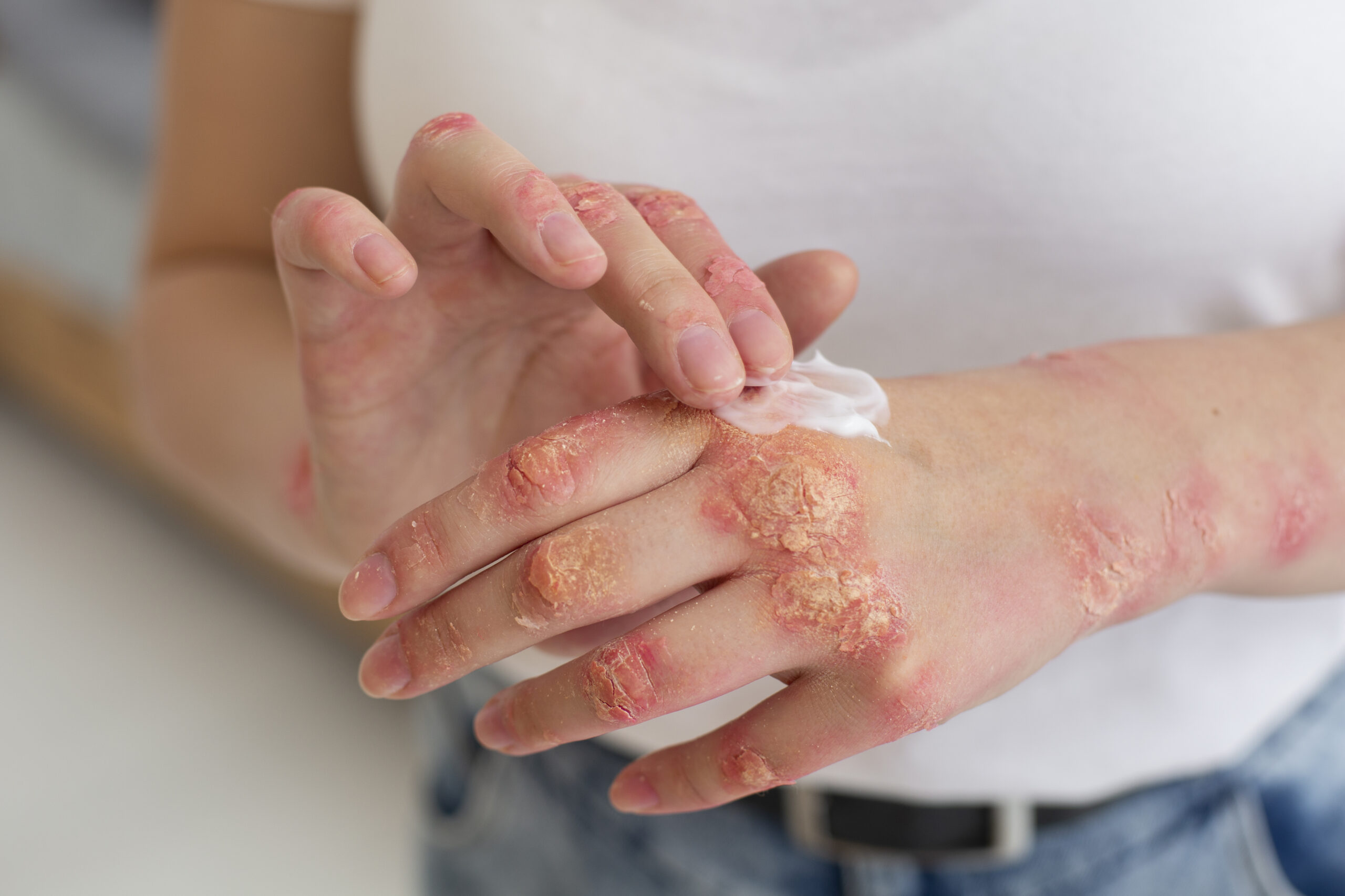 Contact Dermatitis