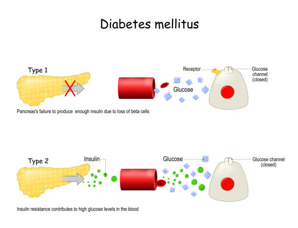 Type 1 Vs. Type 2 Diabetes