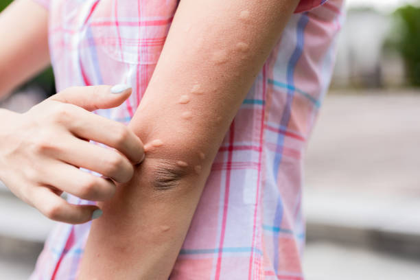Hives vs. Rash
