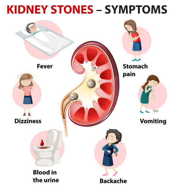 Kidney Stone Symptoms