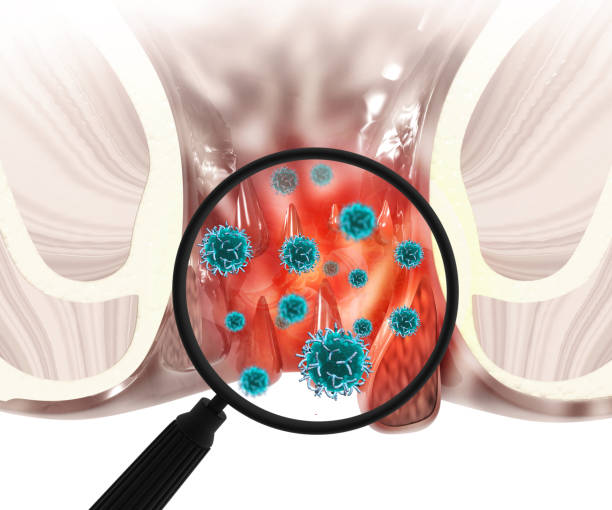 Haemorrhoid