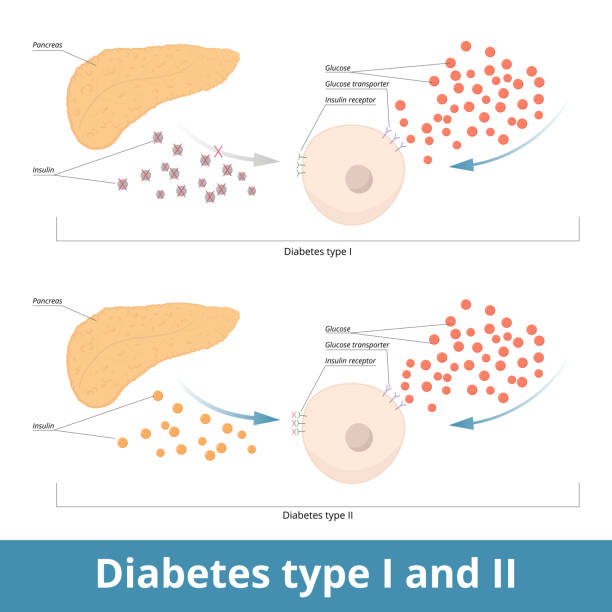 Type 1 Vs. Type 2 Diabetes