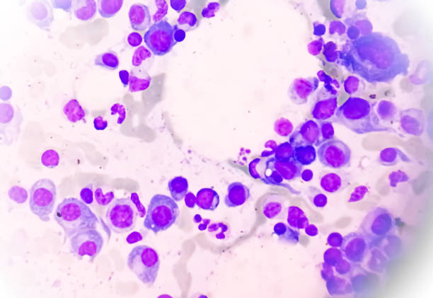 Multiple Myeloma