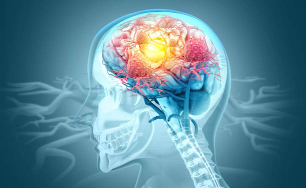 COVID Headache