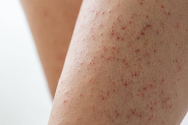 Keratosis Pilaris
