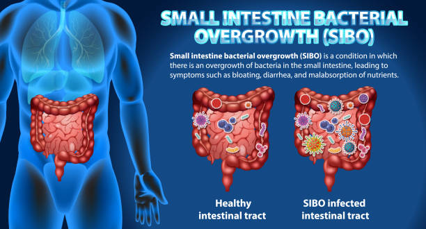  Symptoms of SIBO