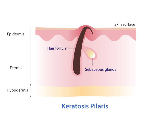 Keratosis Pilaris