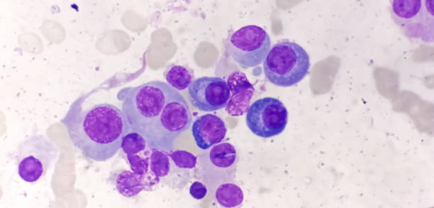 Multiple Myeloma