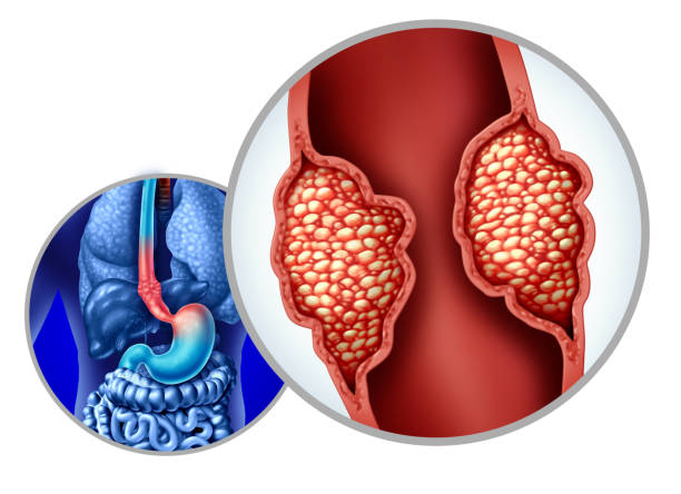Stage 4 Esophageal Cancer