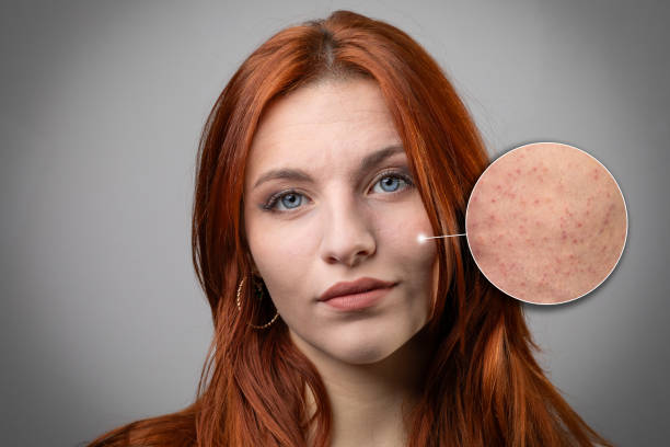 Keratosis Pilaris