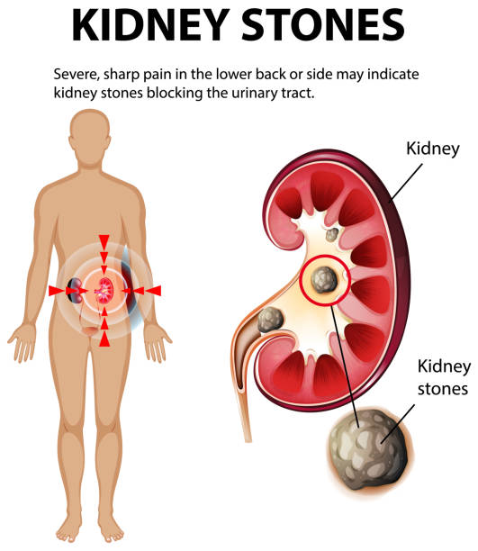 Kidney Stone Symptoms