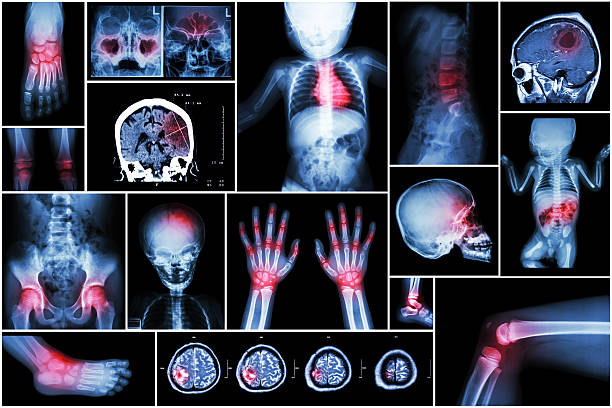 Tardive Dyskinesia