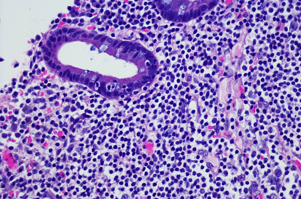 Hodgkin lymphoma 