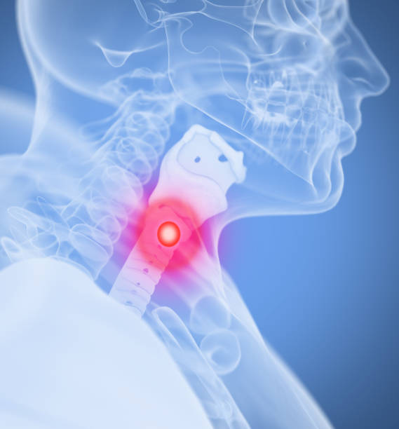 Stage 4 Esophageal Cancer