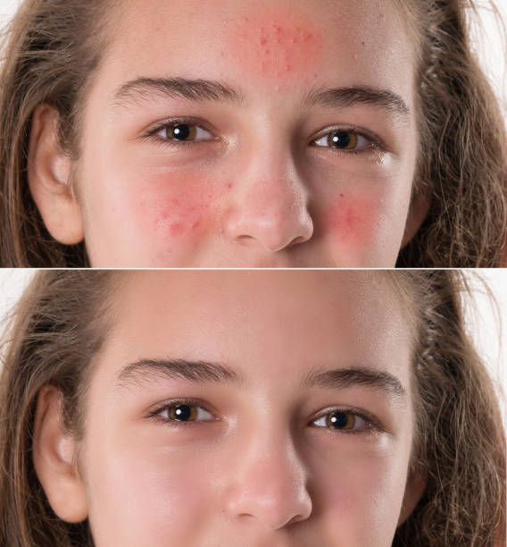 Lupus Rash & Rosacea