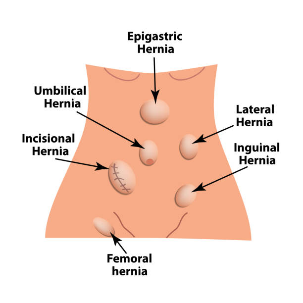 Epigastria Hernia