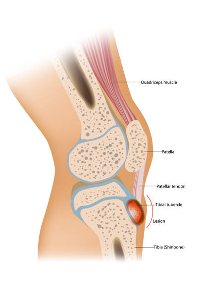 Patellar Tendinitis