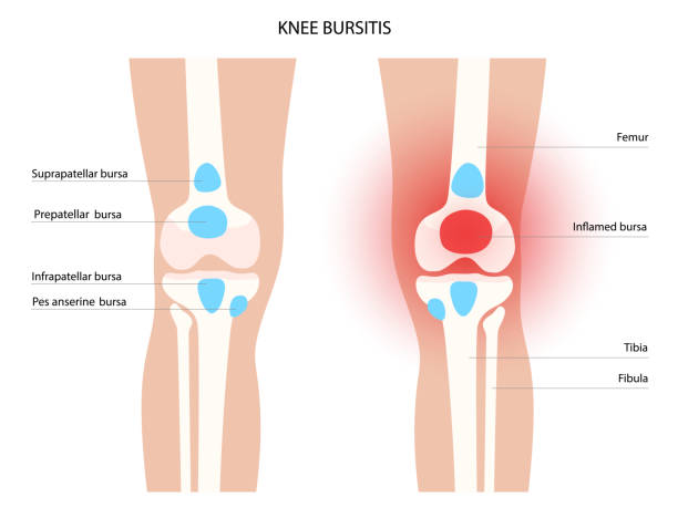 Patellar Tendinitis