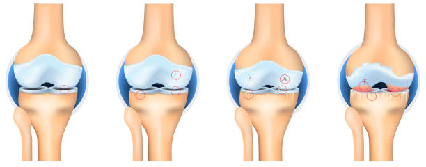 Patellar Tendinitis